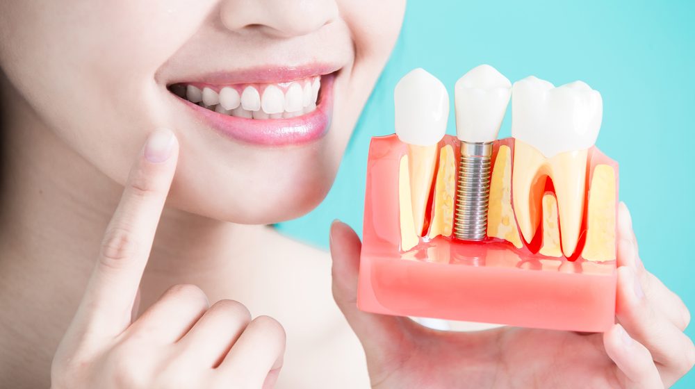 Výhody a nevýhody zubných implantátov